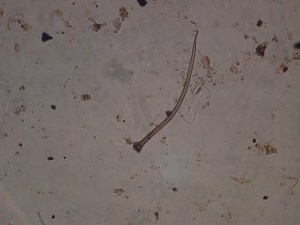 A melanised fungal hyphae - these dark coloured fungi have thick cell walls and are clearly visible through a normal microscope